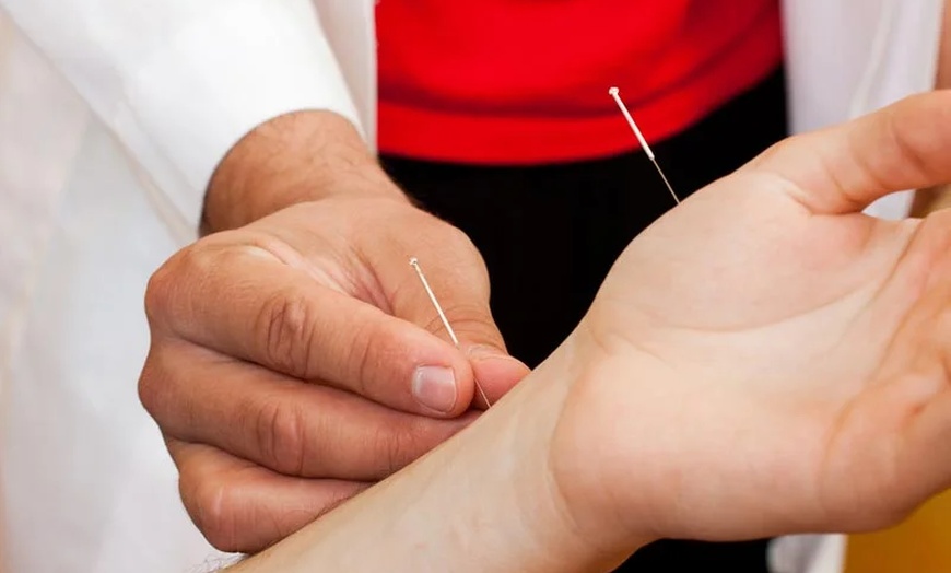 Image 4: Holistic Healing with Acupuncture or Fire Cupping + Biofeedback