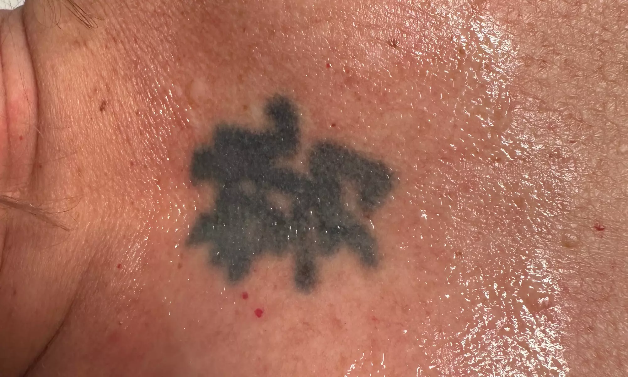 9-Session Laser Tattoo Removal for Areas Less than 1 in up to 88 Sq In