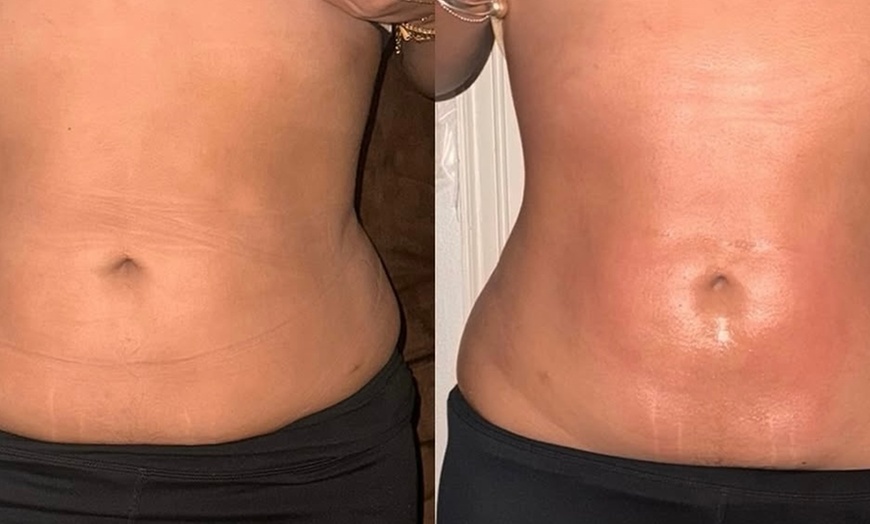 Image 1: Up to 30% Off on Ultrasonic Fat Reduction at AZ Esthetics and Head Spa