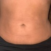 Image 1: Up to 37% Off on Ultrasonic Fat Reduction at AZ Esthetics and Head Spa