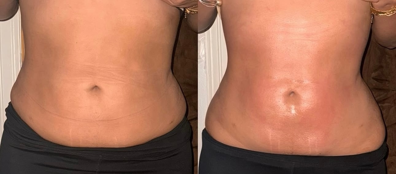 Up to 37% Off on Ultrasonic Fat Reduction at AZ Esthetics and Head Spa