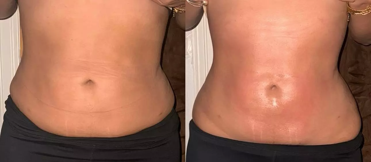 Up to 30% Off on Ultrasonic Fat Reduction at AZ Esthetics and Head Spa