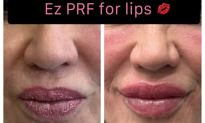 Image 3: PRF Under-Eye Rejuvenation & Organic EZ Gel Facial Balancing Sessions
