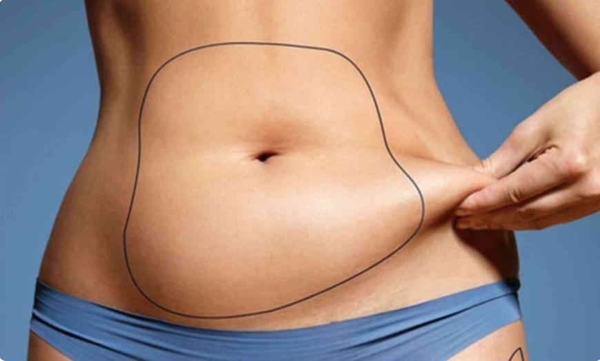Image 1: Cryolipolysis Fat Freezing on Two Areas at Vibration Cafe