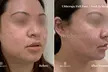 Experience skin lifting and tightening at One Beauty Aesthetics with Ultherapy treatments for chest or neck, up to 60% off - Second Medium