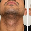 Image 2: Targeted Facial Hair Electrolysis: 45, 60, or 90-Min Sessions