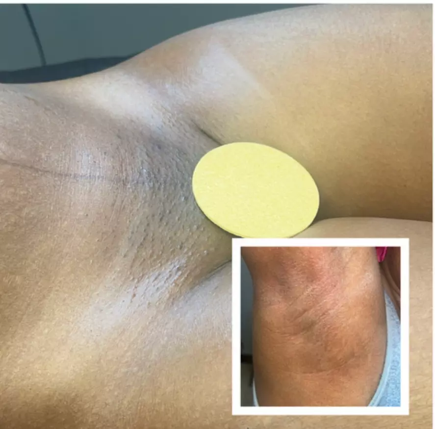 Wax Packages: One, Two. or Three Brazilian Wax or One Full Body Waxing