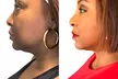 Up to 58% Off on Facelift - Non-Surgical at Your Sculpt Studio - Second Medium