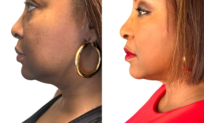 Image 2: Up to 62% Off on Facelift - Non-Surgical at Your Sculpt Studio
