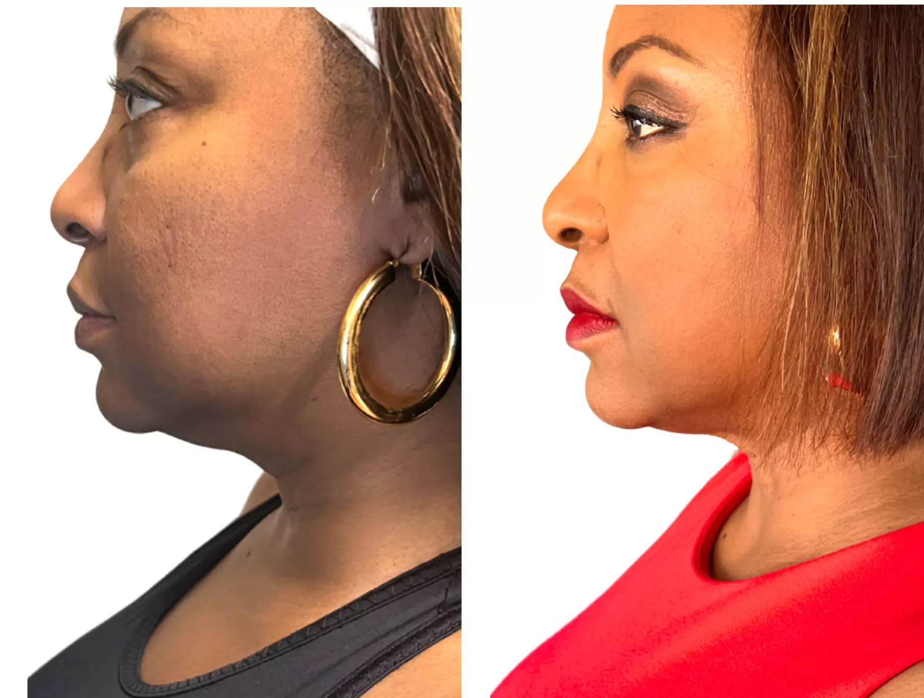Up to 62% Off on Facelift - Non-Surgical at Your Sculpt Studio