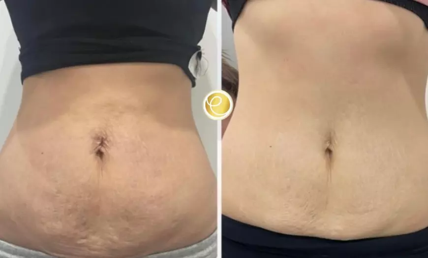 Image 1: Up to 75% Off on Fat-Freezing Cryolipolysis