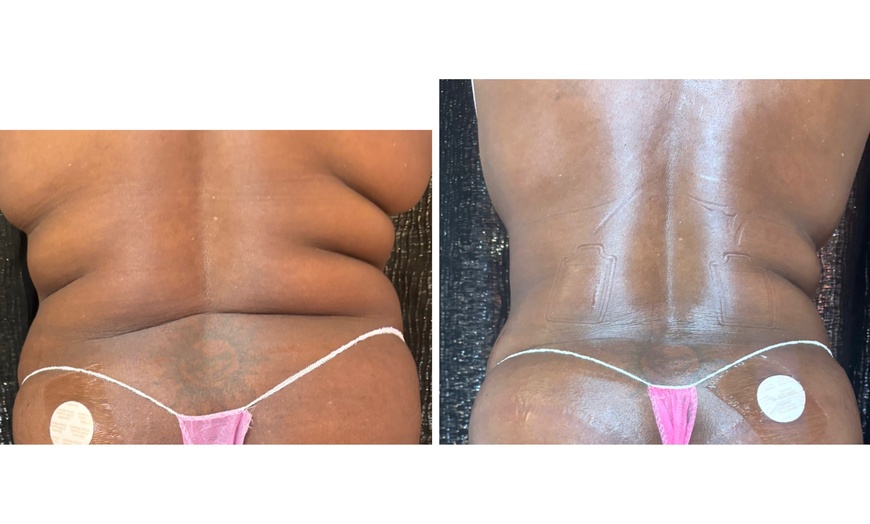 Image 5: Up to 37% Off on Cavitation at Extreme body sculpting