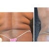 Image 5: Up to 37% Off on Cavitation at Extreme body sculpting