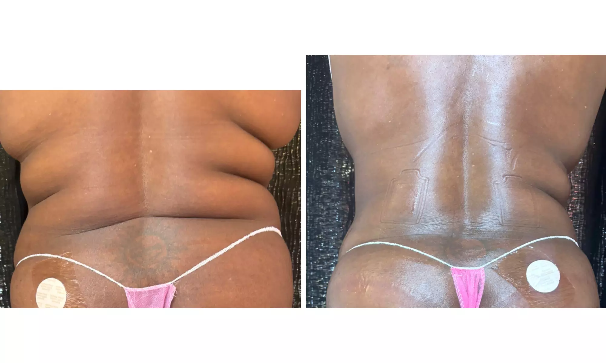 Up to 30% Off on Cavitation at Extreme body sculpting