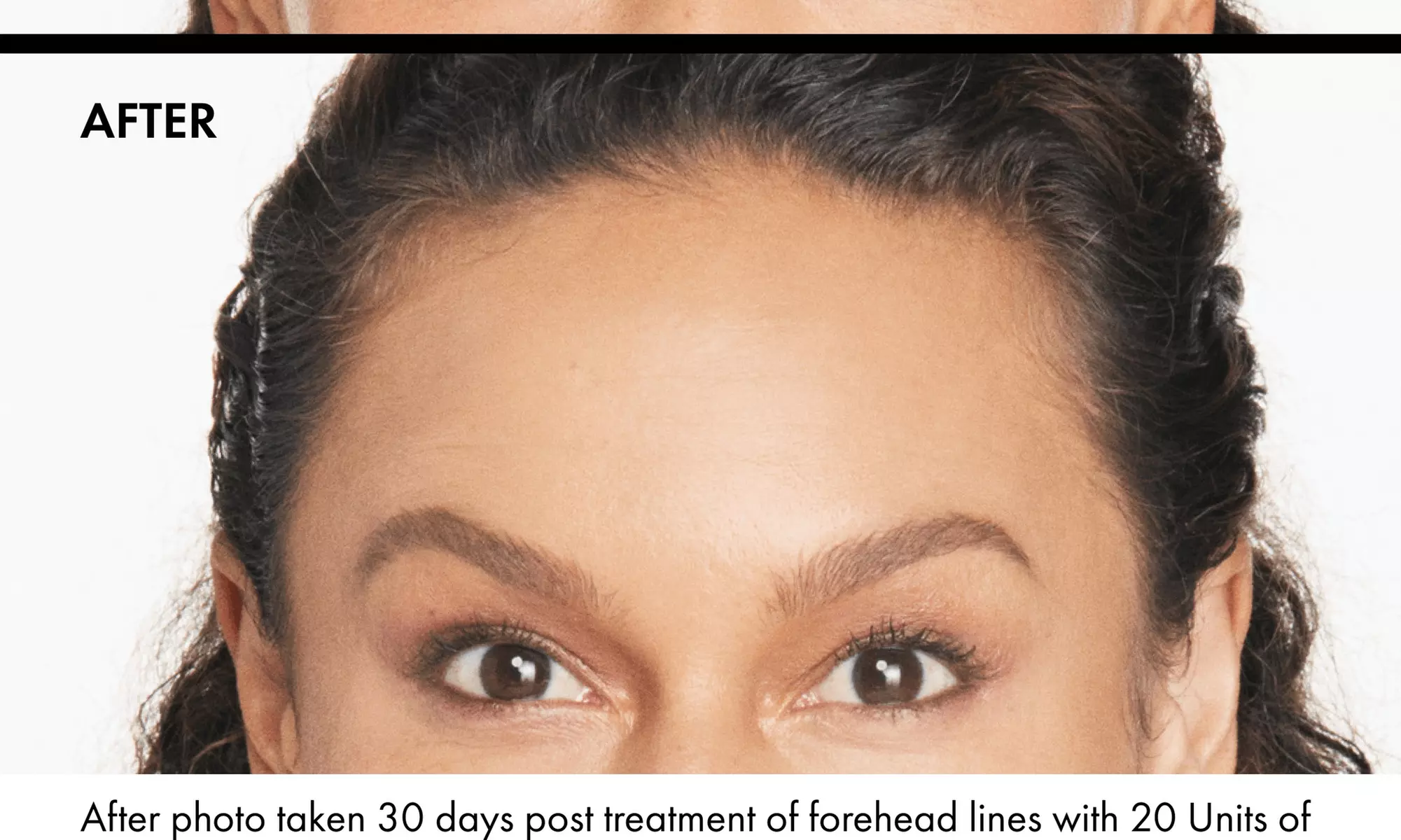 Achieve Radiant Confidence with 20, 40, 60, or 80 Units of Xeomin