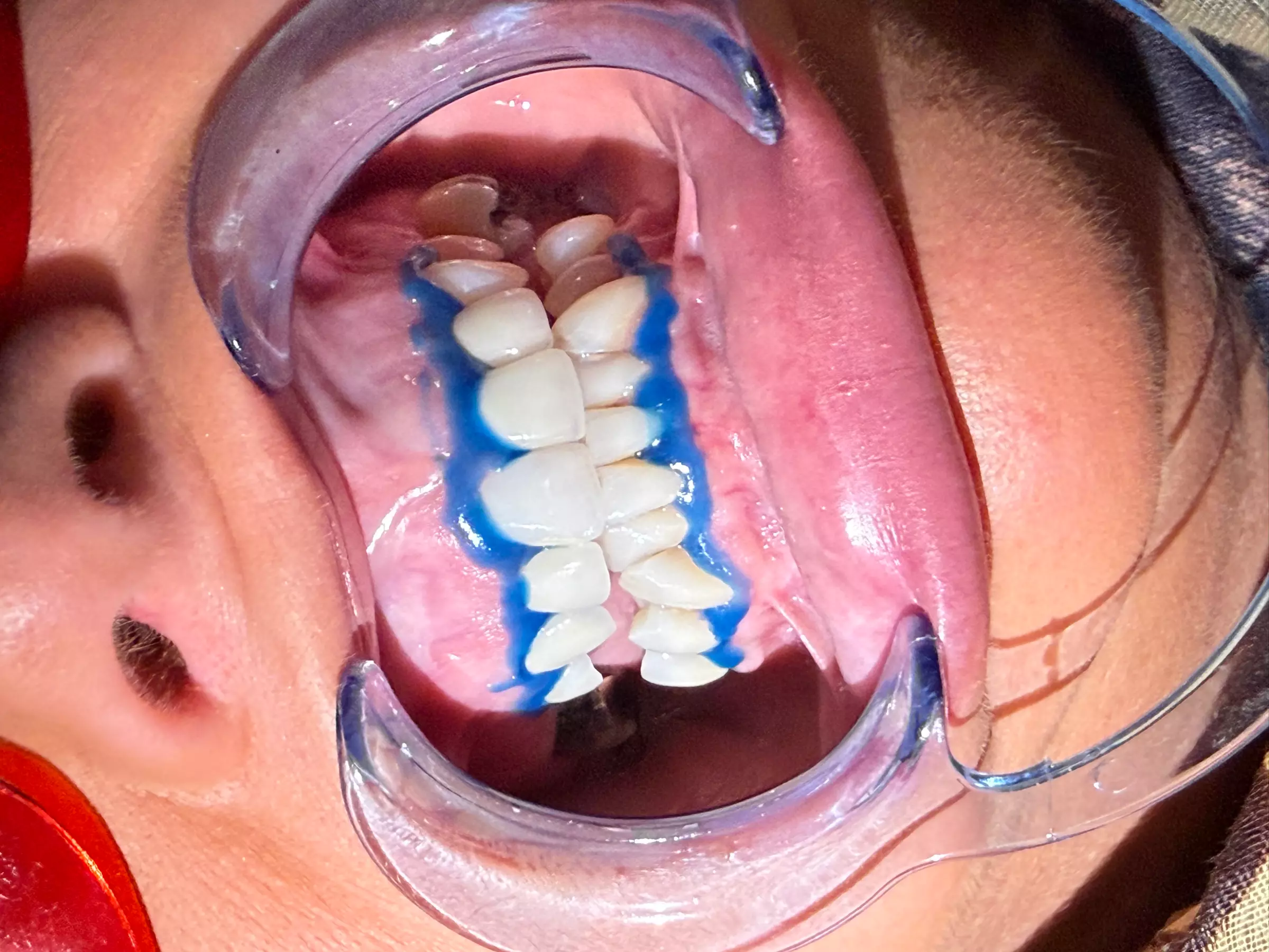 Blanchiment dentaire avec L’atelier de Chloé