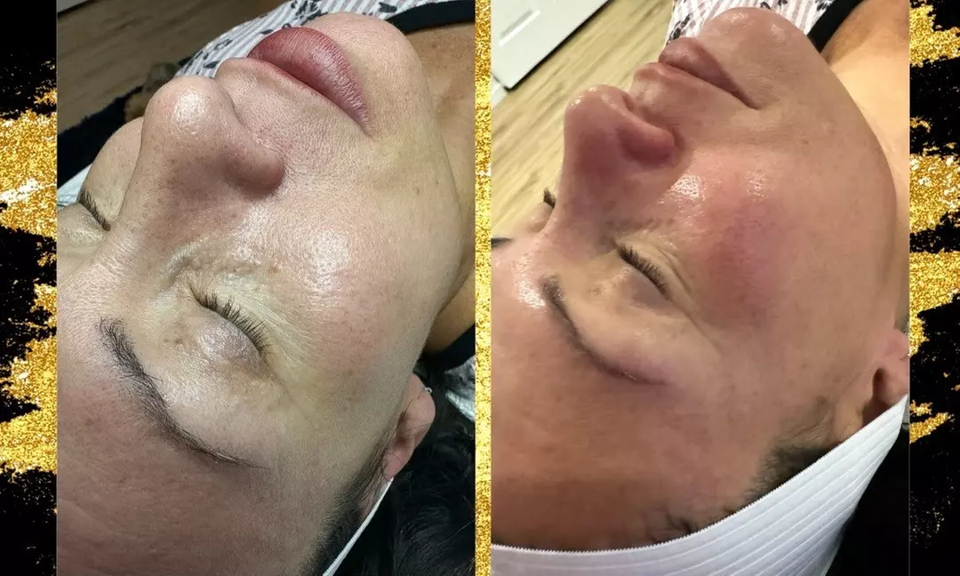 60-Min Blackheads Extraction & LED Light Therapy Available