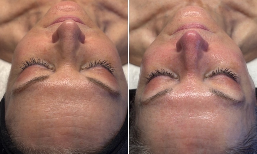 Image 4: One, Two, or Three 30-Minute Signature Hydrafacial Session for One