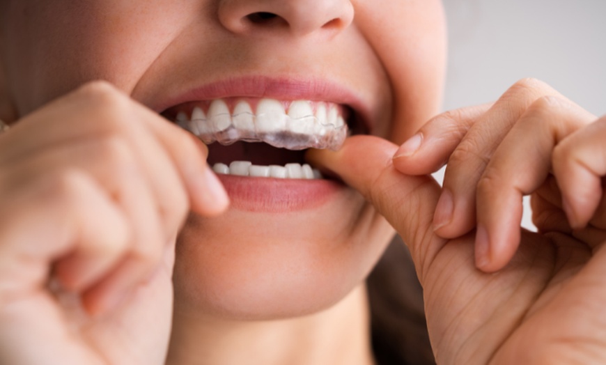 Image 1: Invisible Aligners - Top and Bottom Arch (6 or 12 Aligners)