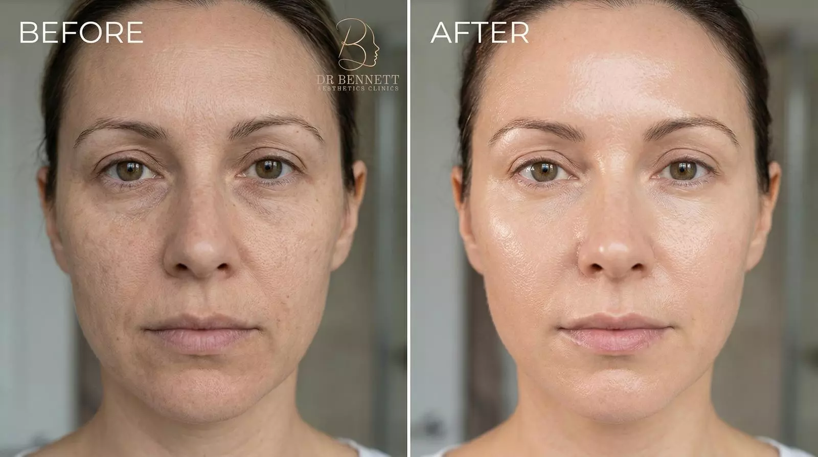 Dr Bennett Aesthetics Clinics From 74 London Groupon dr-bennett-aesthetics-clinics-from-74-london-groupon