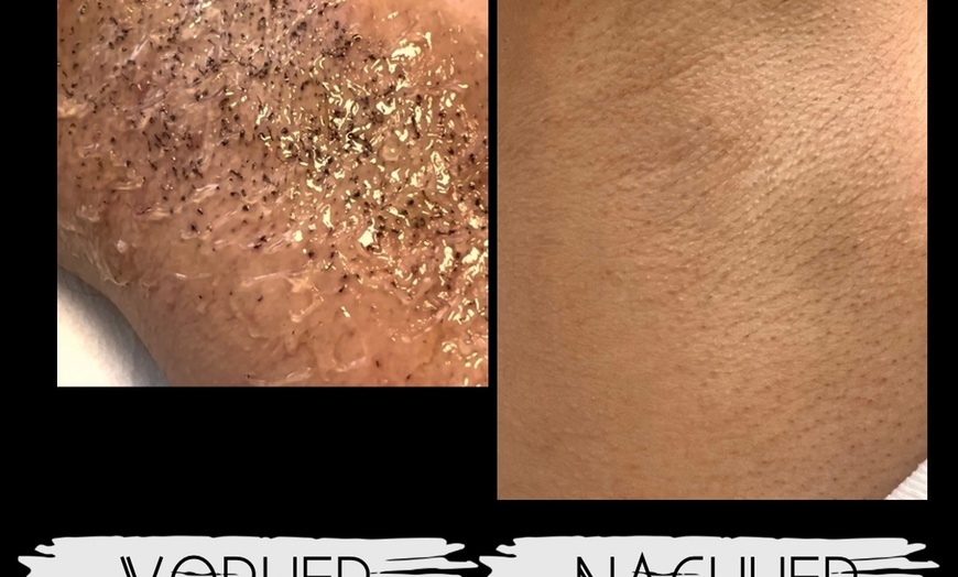 Image 3: Diodenlaser-Haarentfernung für Achseln, Intimbereich od. Unterschenkel