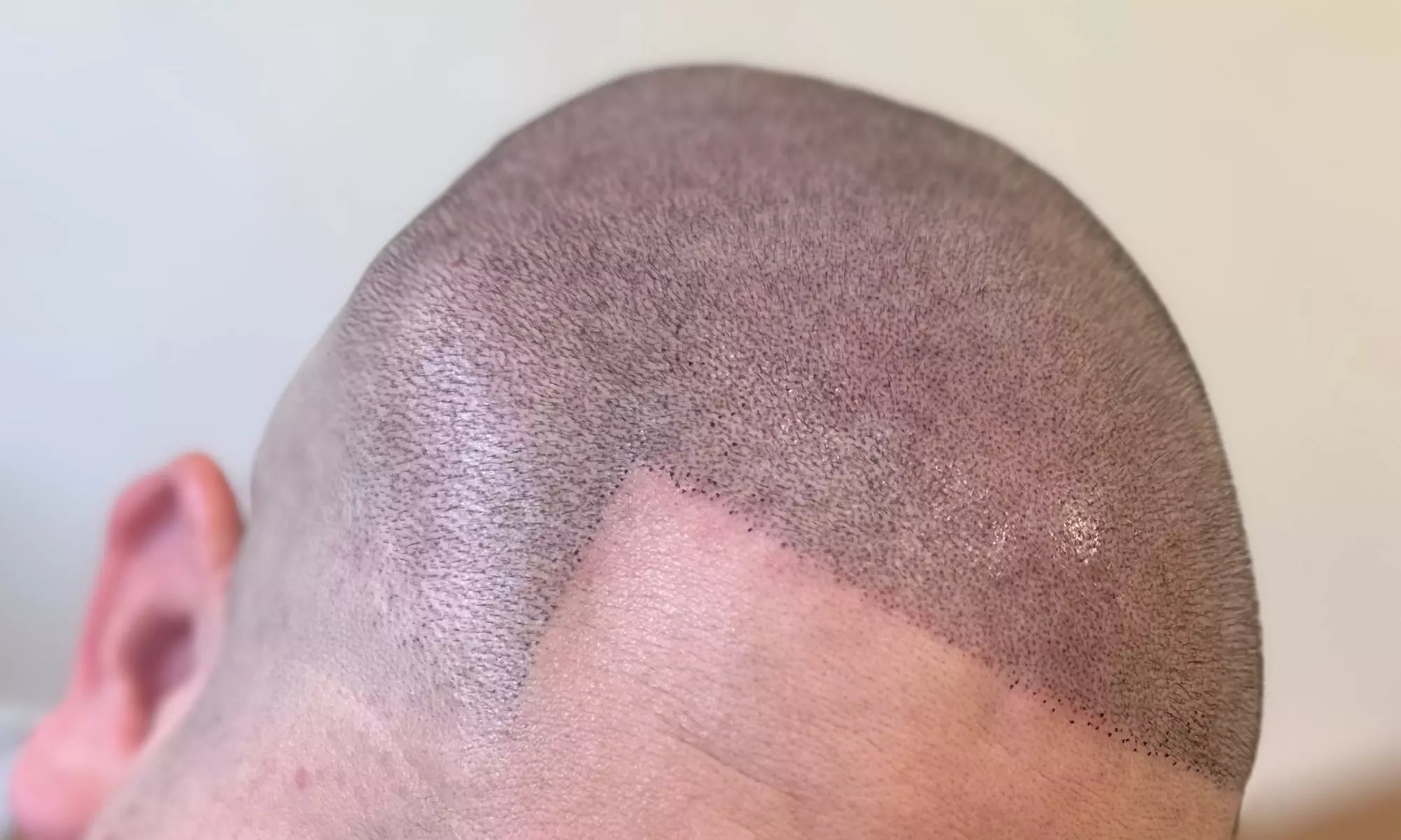 Up to 50% Off on Tattooing at Hairlines & Beyond Scalp Micropigmentation - Second Medium