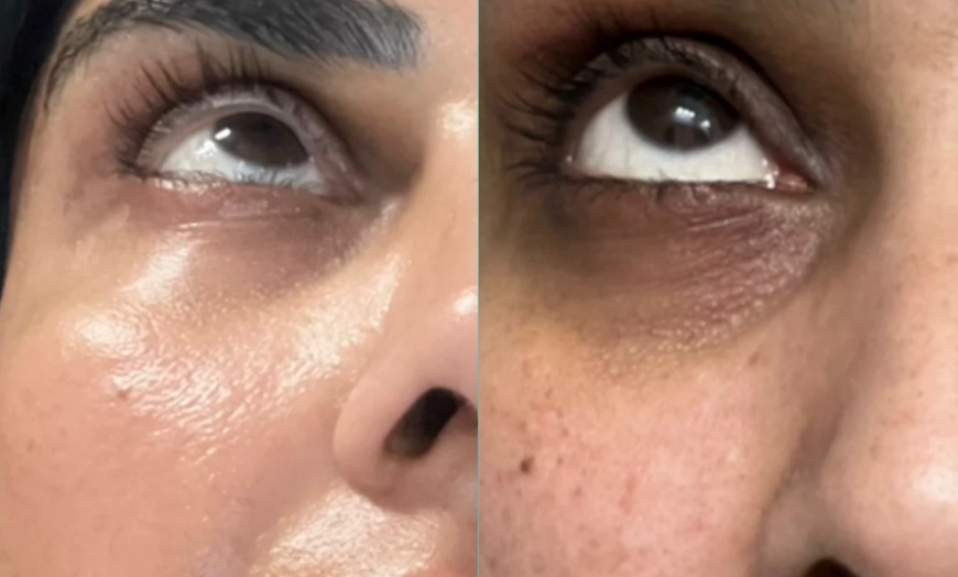 Image 2: Up to 59% Off on Vampire Facelift, PRP and PRF 