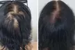 Scalp Micropigmentation Hair-Loss Treatment - Crown, Front, or Filler (Density Effect) - Women/Men(Up to 44%Off) - Second Medium