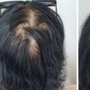 Image 4: Scalp Micropigmentation Hair-Loss Treatment - Crown, Front, or Filler