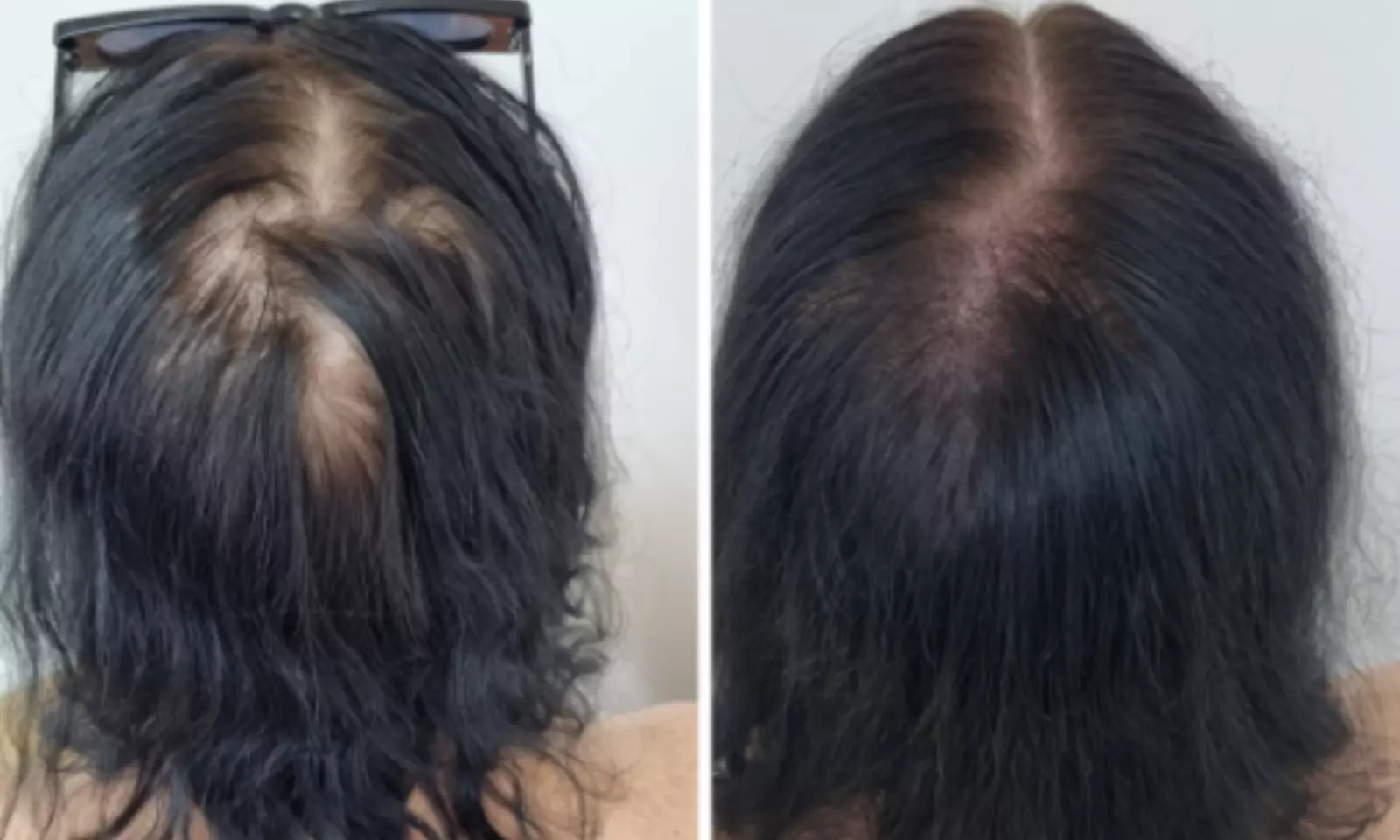Scalp Micropigmentation Hair-Loss Treatment - Crown, Front, or Filler