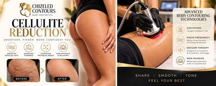 Two Cellulite-Reduction Treatments - Chizeled Contours Body Aesthetics