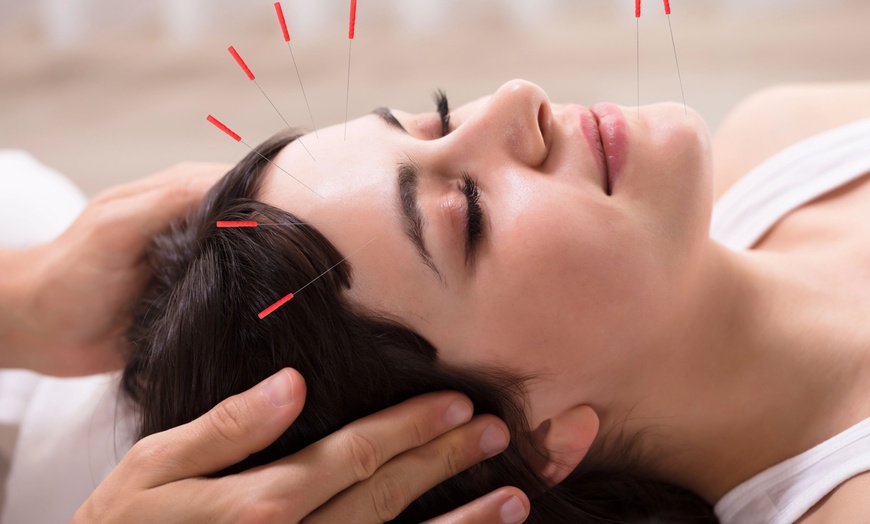 Image 2: Holistic Healing with Acupuncture or Fire Cupping + Biofeedback