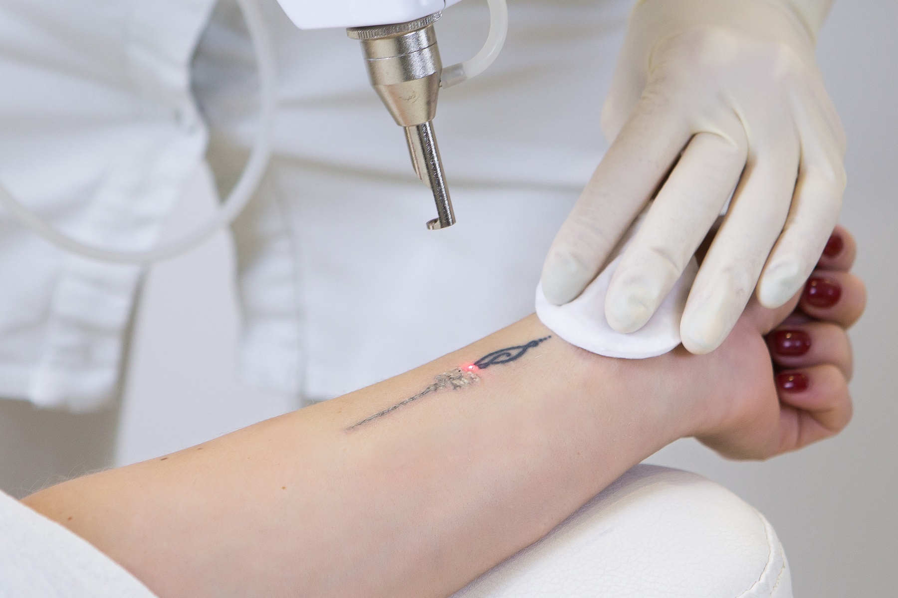 One Tattoo removal with Laser