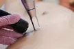 Experience Laser By Nicole - Fort Lauderdale with three tattoo removal treatments for various area sizes up to 37% off - Second Medium