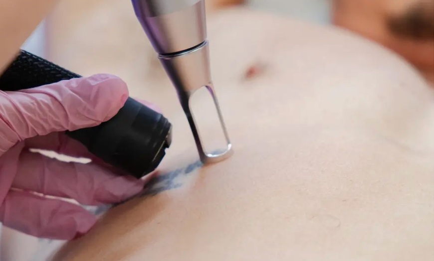 Image 3: Experience Laser By Nicole - Fort Lauderdale with three tattoo removal treatments for various area sizes up to 37% off