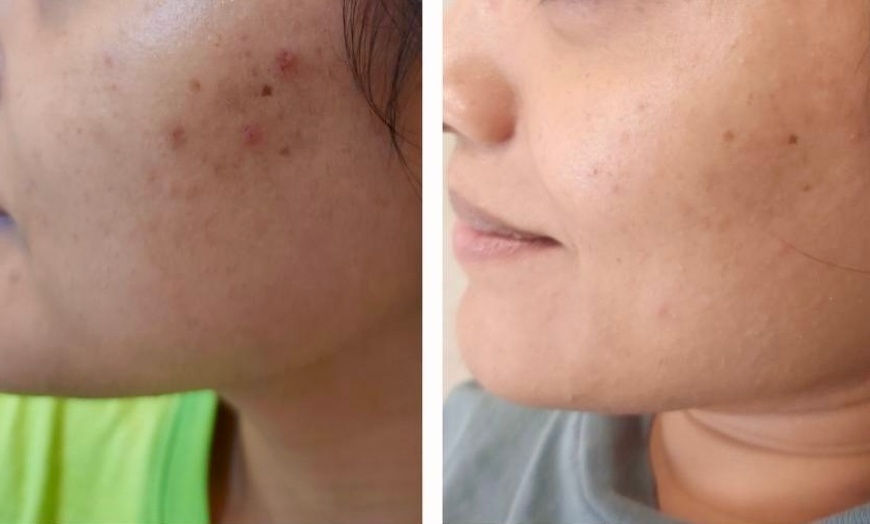 Image 3: Experience a Revitalizing VI Peel or Diamond Glow Facial at Enigma Medi Spa & Laser Center (Up to 44% Off)