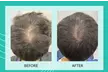 Up to 55% Off on Laser Hair Restoration at Rainier Laser and Aesthetics Center - Second Medium
