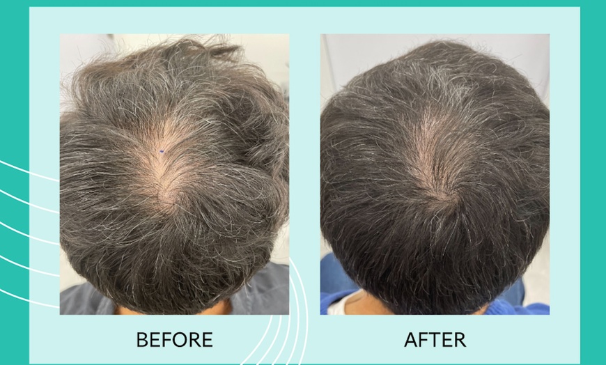 Image 4: Up to 50% Off on Laser Hair Restoration at Rainier Laser and Aesthetics Center