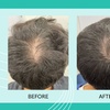 Image 4: Up to 50% Off on Laser Hair Restoration at Rainier Laser and Aesthetics Center