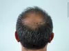 Explore Natural 1,2, or 3 PRP Hair Restoration Treatment at Shungo Care (Up to 31% off)