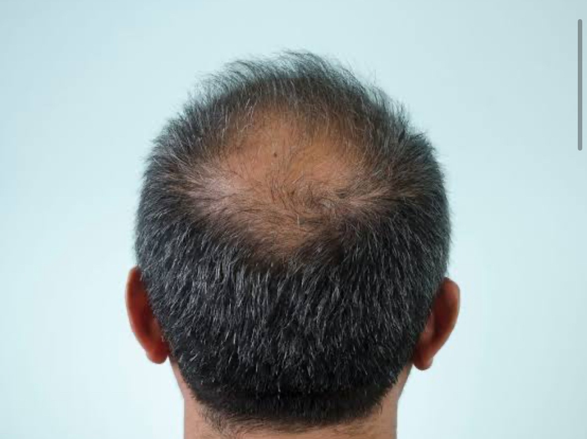 Explore Natural 1,2, or 3 PRP Hair Restoration Treatment