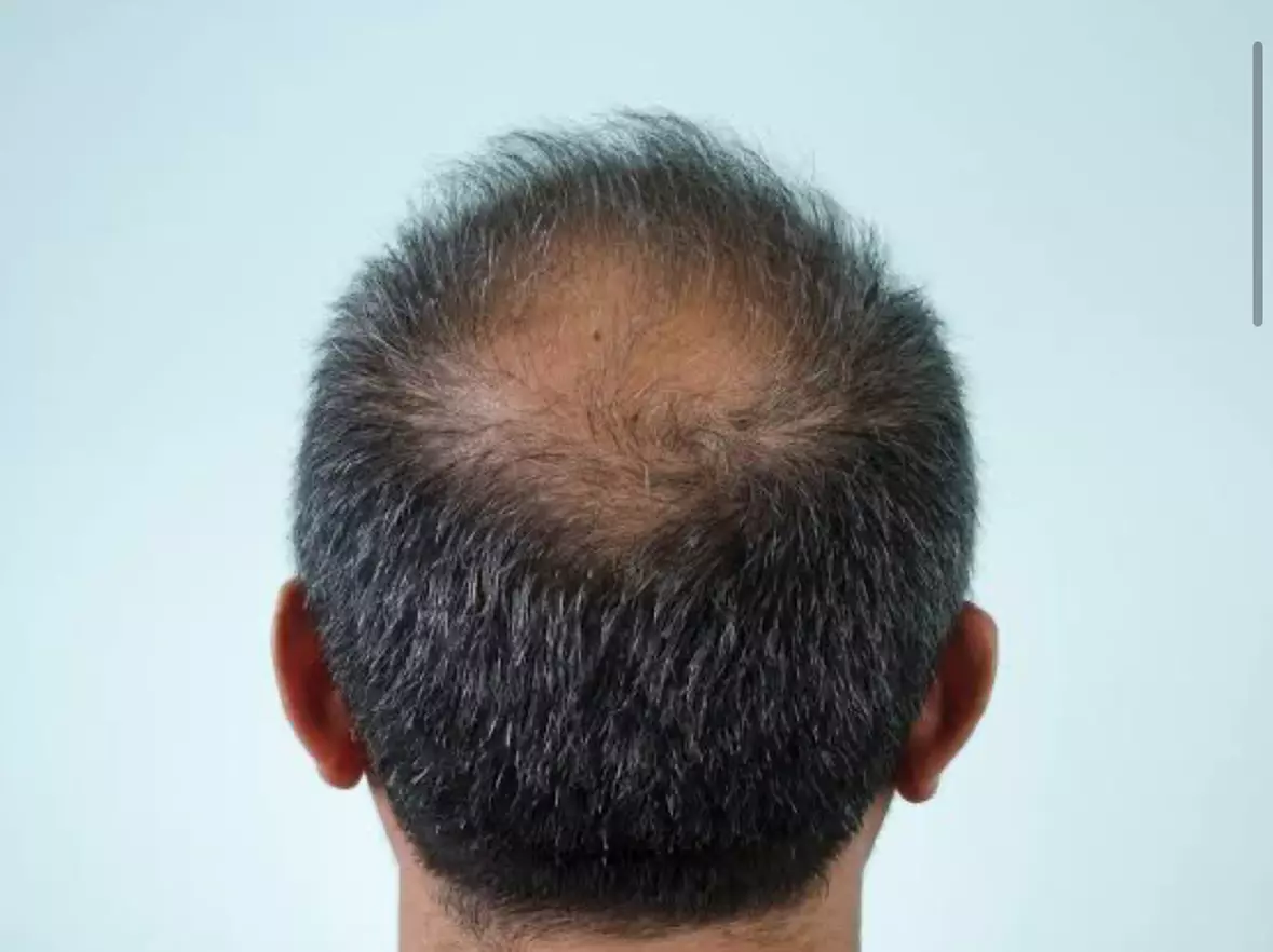 Explore Natural 1,2, or 3 PRP Hair Restoration Treatment at Shungo Care (Up to 31% off) - Primary Image