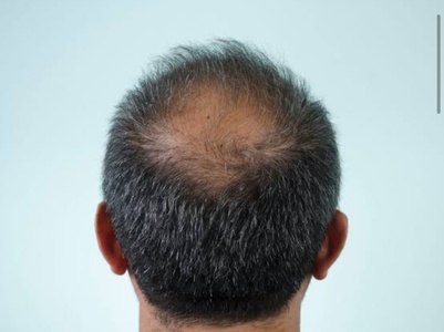 One PRP Hair Restoration Treatment - Shungo Care