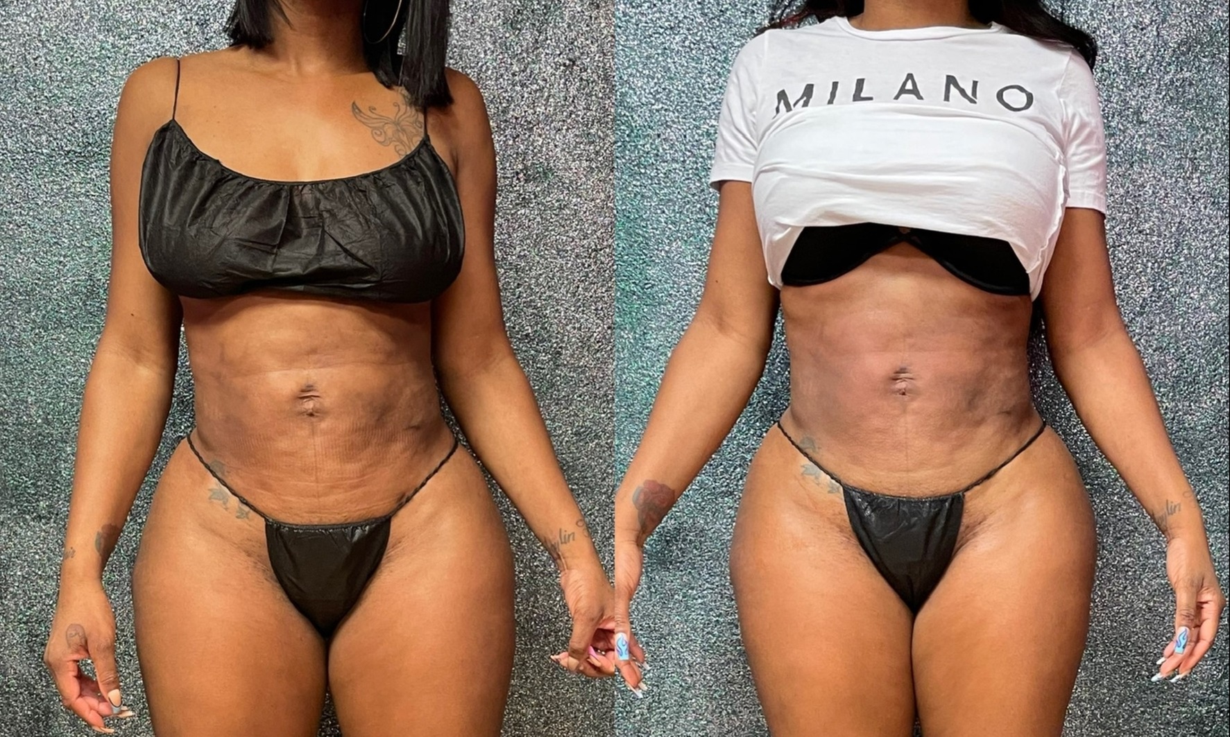 Up to 60% Off on Radio Frequency Skin Tightening at OBNoxious Beauty Body Sculpting Atlanta
