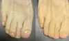 Get Rid of Toenail Fungus with Laser Treatment at Michigan Avenue Podiatry (Up To 91% Off)