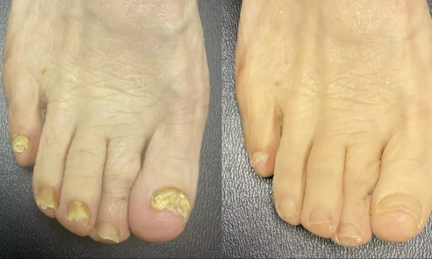 Get Rid of Toenail Fungus with Laser Treatment at Michigan Avenue Podiatry (Up To 91% Off) - Primary Image