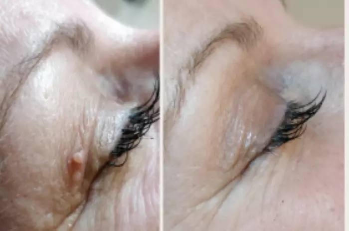 Effective Skin Tag and Brown Spot Removal Options Available