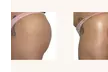 Non-Surgical Butt Lift at The Shape Shop Norterra (Up to 52% Off) - Second Medium