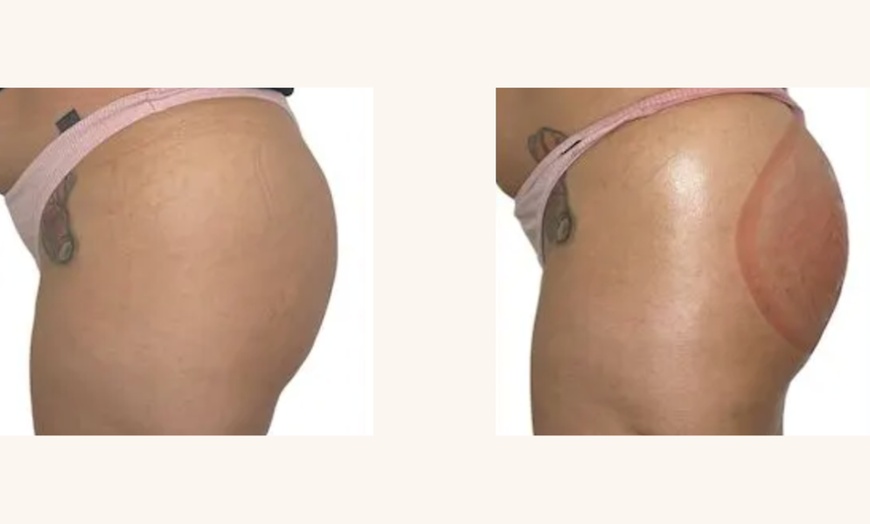 Image 2: Up to 47% Off on Non-Surgical Butt Lift
