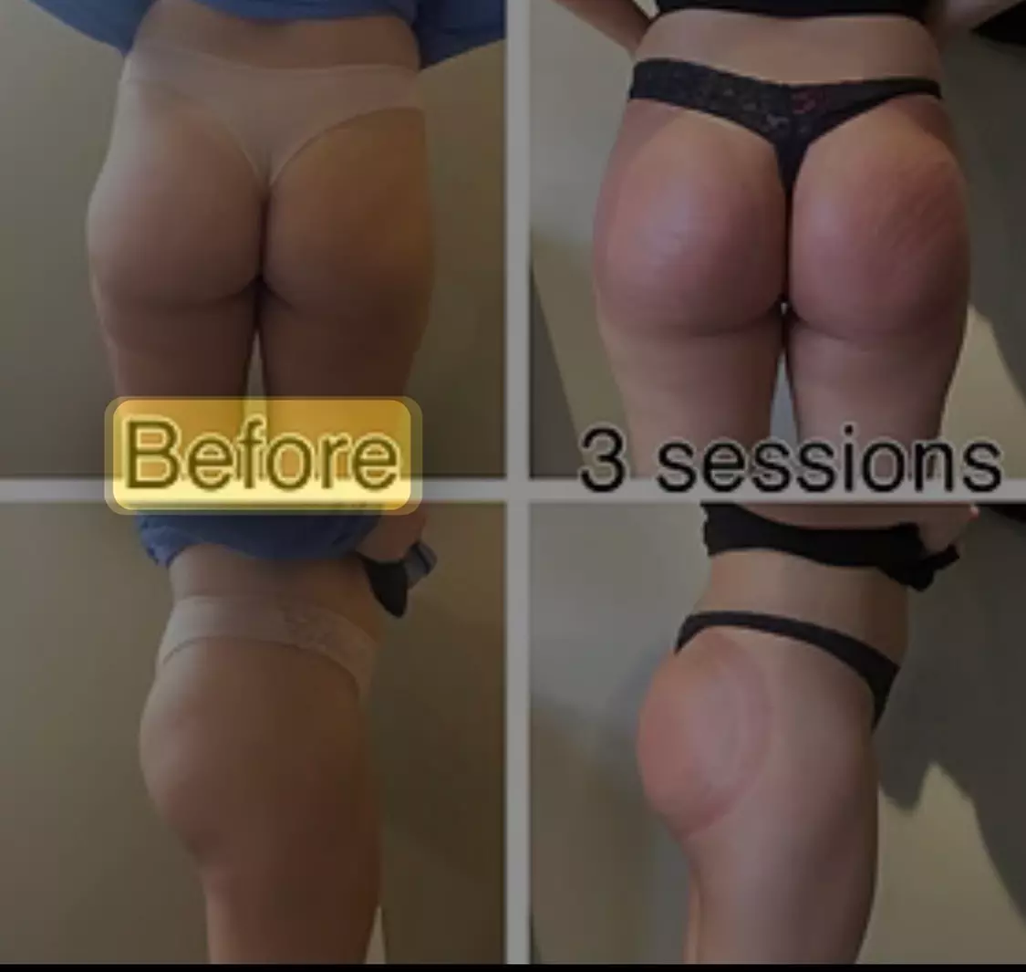 Up to 61% Off on Non-Surgical Butt Lift at Soul Shape Body And Mind Spa - Primary Image